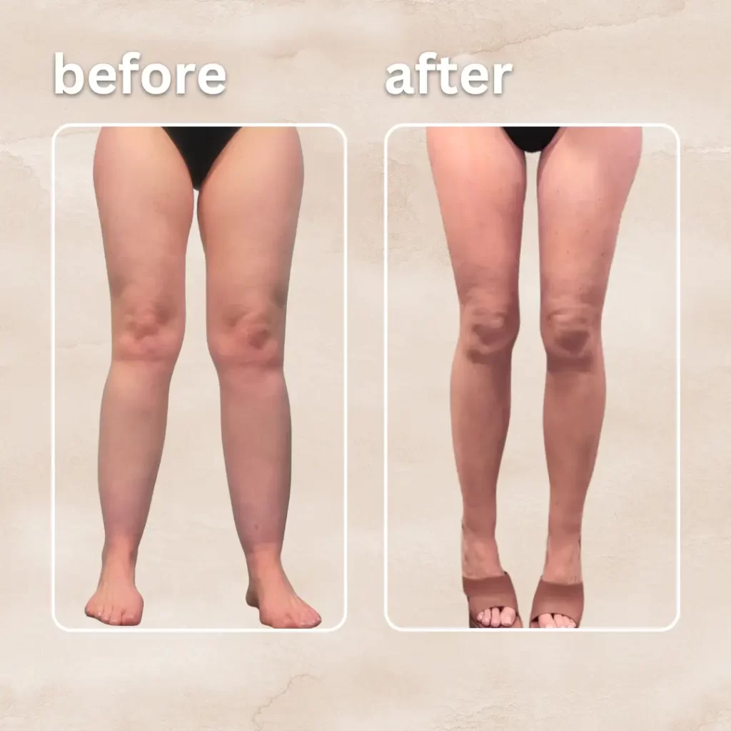 Before and after images showcasing a woman's legs post-lipedema lipo treatment, highlighting significant transformation.