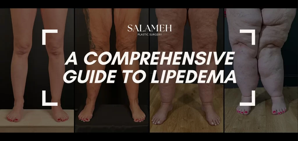 A comprehensive guide to lipedema blog feaured photo