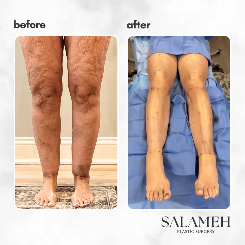 Before and after photos showcasing the transformation of a woman's legs following LippyLipo treatment.