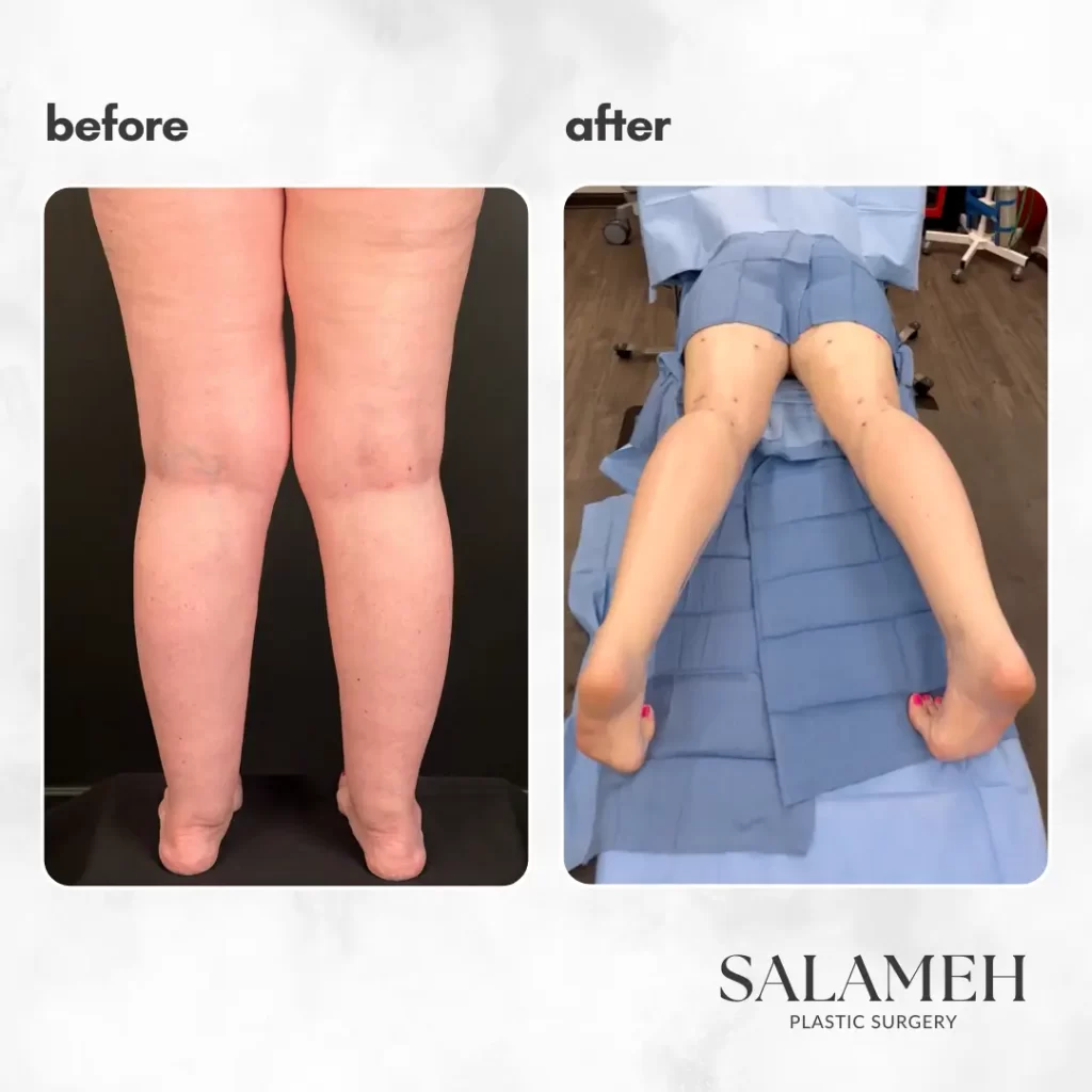 Before and after images depicting the results of LippyLipo on a woman's legs, highlighting significant improvement.