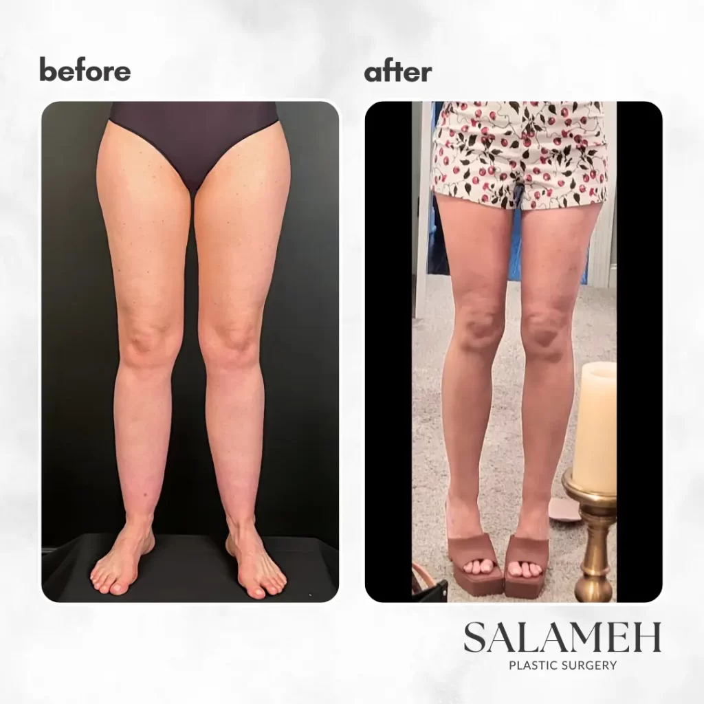 Before and after photos showcasing the transformation of a woman's legs following LippyLipo treatment.