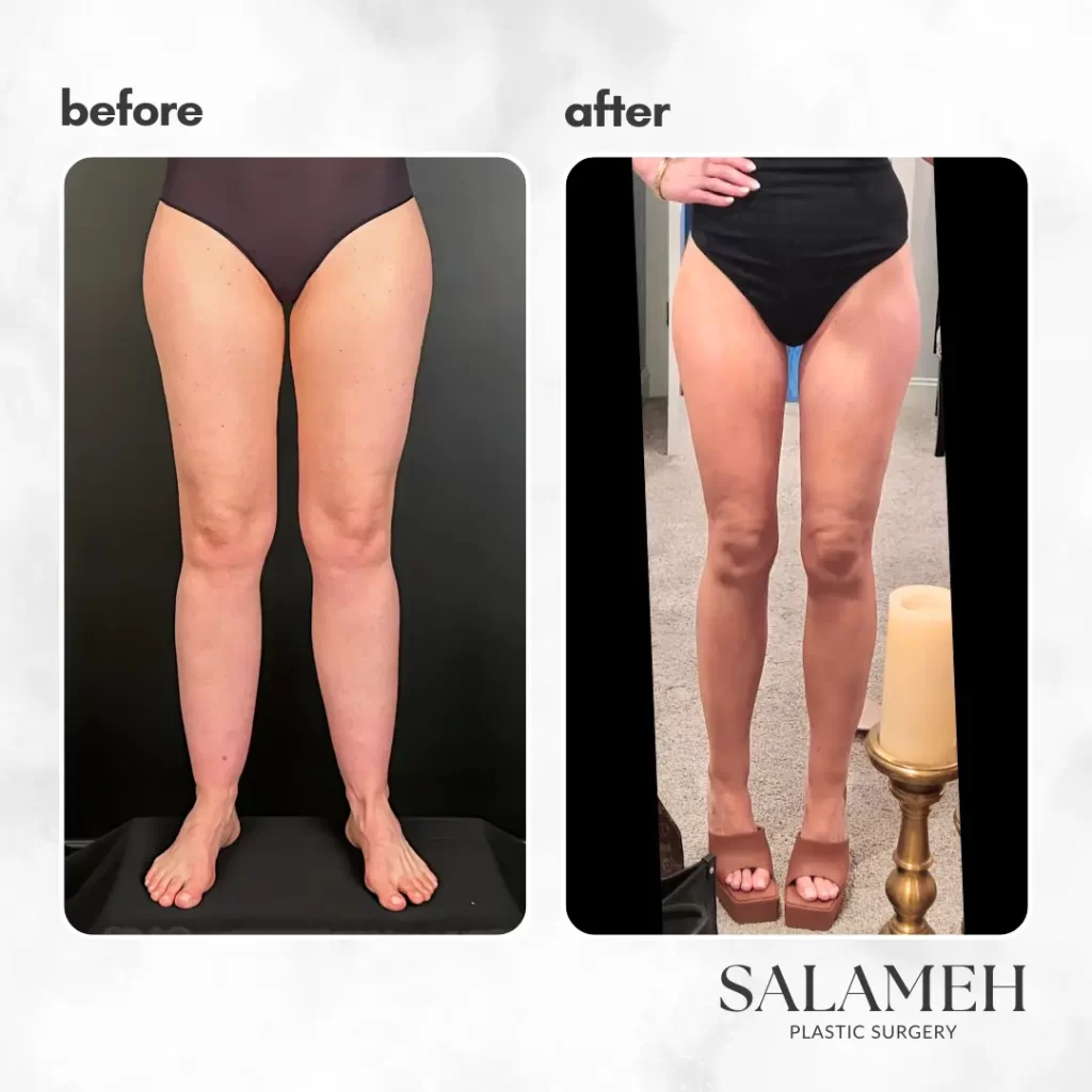 Before and after images depicting the results of LippyLipo on a woman's legs, highlighting significant improvement.