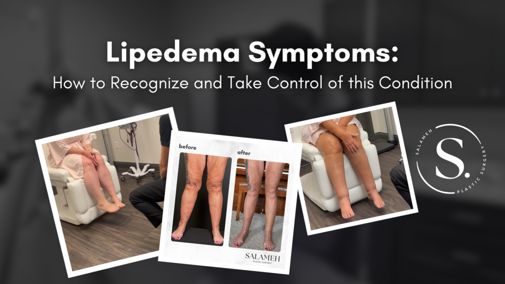 Lipedema Symptoms How to Recognize and Take Control of this Condition