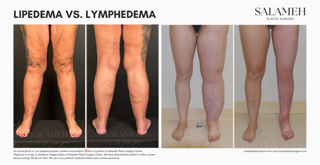 Lipedema vs. lymphedema actual photo illustration.
