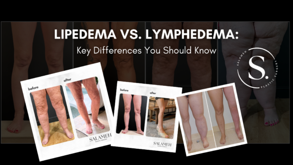 Unterschied Zwischen Lipödem Und Lymphödem salamehplasticsurgery.com