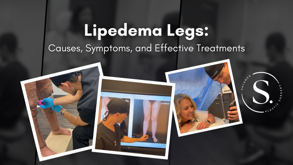 Understanding Lipedema Legs: Causes, Symptoms, and Treatment