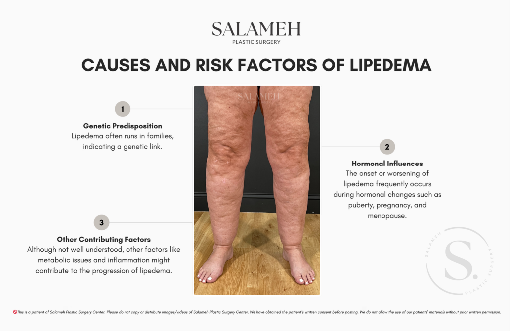 Causes and Risk Factors of Lipedema. Important things to know about lipdema surgery.