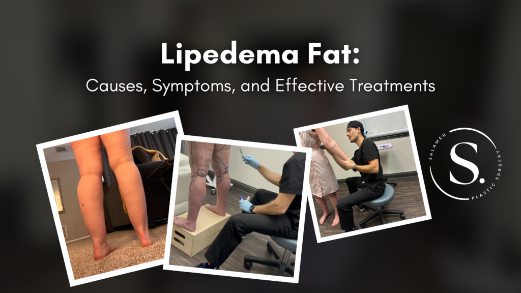 Lipedema fat featured photos showing patients with lipedema