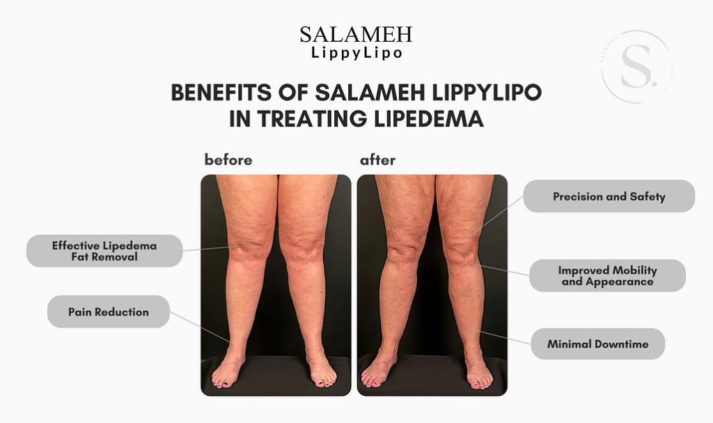 Benefits of Salameh LippyLipo in Treating Lipedema Fat